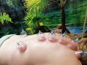 Cupping behandeling Amersfoort